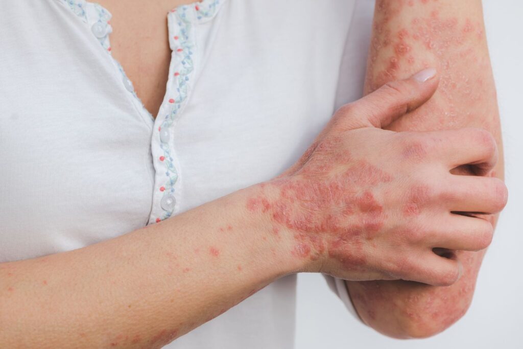 Psoriasis and ayurveda